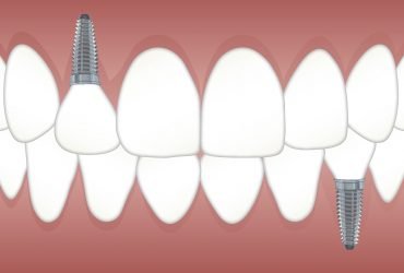 Dental Implants in Jaipur