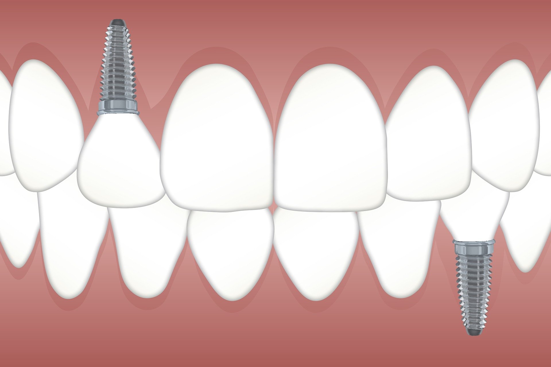 Dental Implants in Jaipur