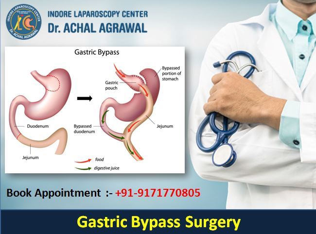 Dr. Achal Agrawal Specialist at Indore Laparoscopy Center