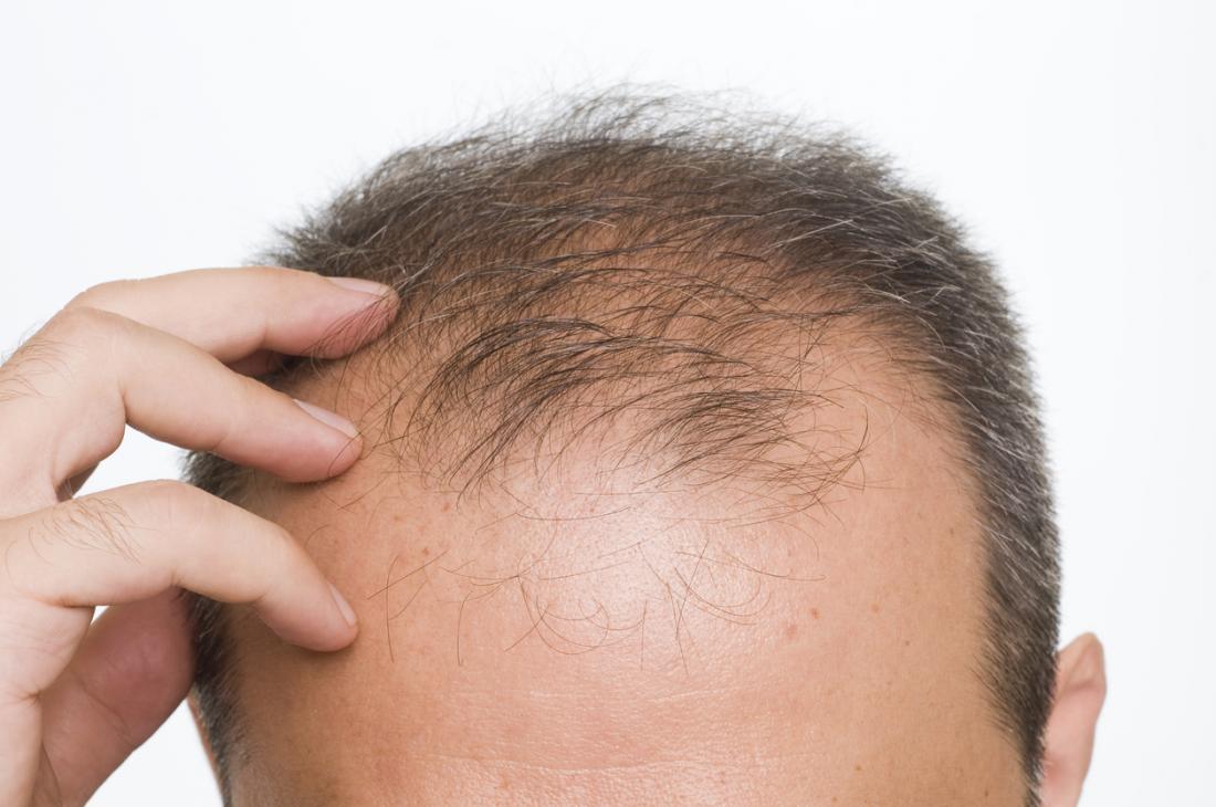 Quality Hair Transplant in Ludhiana by Experienced surgeon