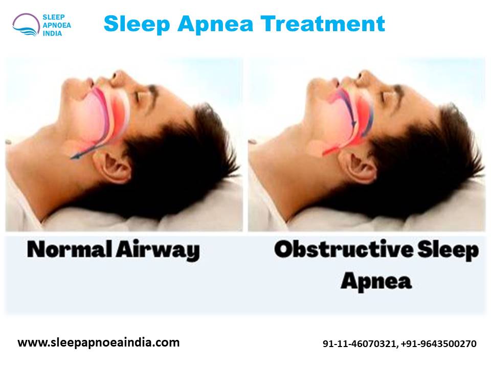 Sleep Apnea Treatment