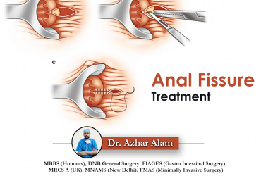 Fissure Doctor in Kolkata | Best Treatment for Fissure