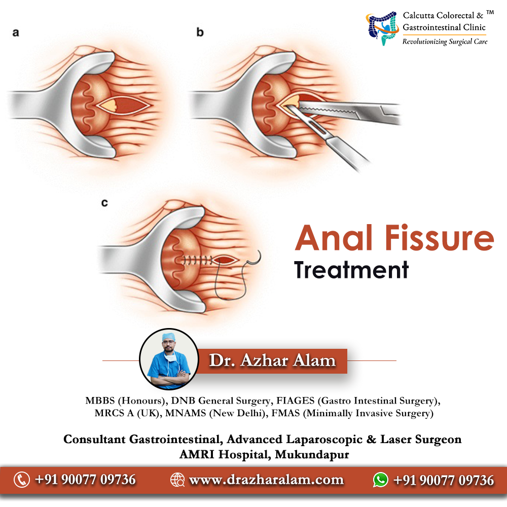 Fissure Doctor in Kolkata | Best Treatment for Fissure