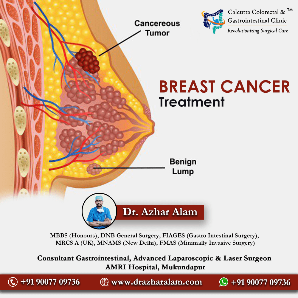 Best Breast Tumor Treatment In Kolkata | Dr. Azhar Alam