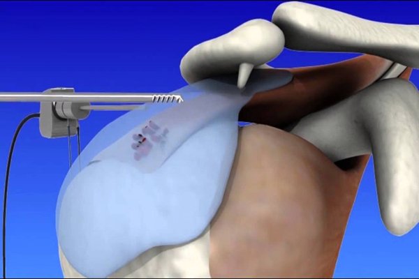 India’s leading shoulder Arthroscopy surgeon in Delhi NCR