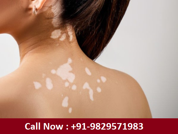 Best Homeopathy Treatment for Vitiligo in DLF Phase 4 | 9829571983