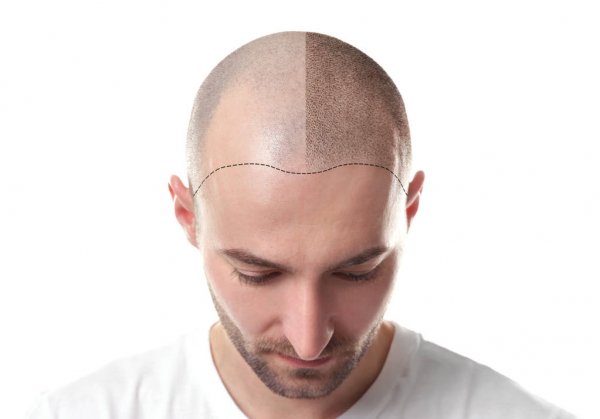 Hair Transplant in Delhi – Dr. Lokesh Handa