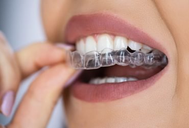 Orthodontic Without Braces Treatment in Gurgaon – Stoma Dentals