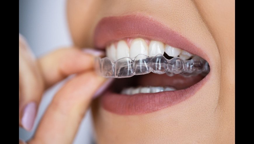 Orthodontic Without Braces Treatment in Gurgaon – Stoma Dentals