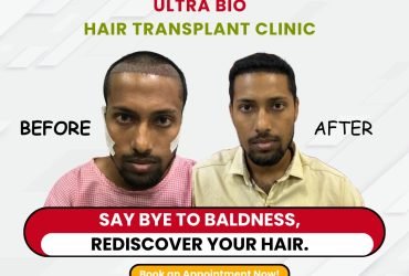 hair transplant clinic chennai