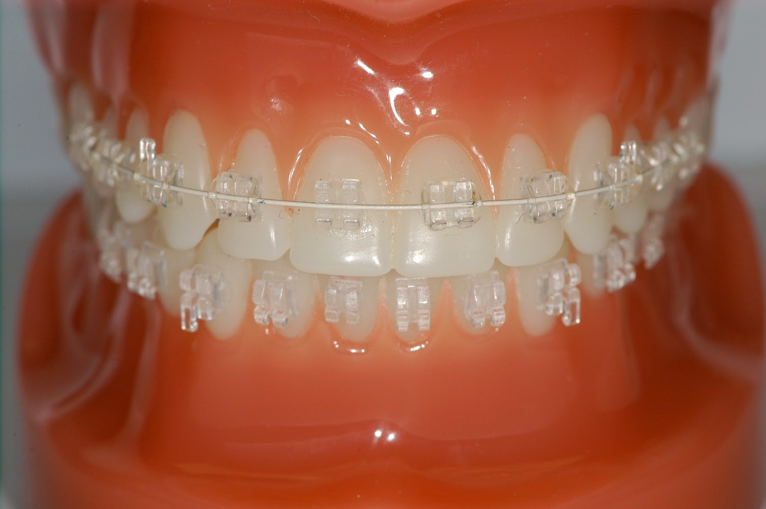 Best Invisible Braces in Bangalore | Dental Braces in Karnataka, India