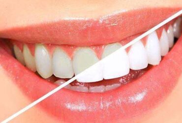 Best Teeth Whitening in Bangalore | teeth whitening cost