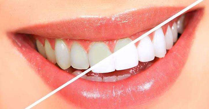 Best Teeth Whitening in Bangalore | teeth whitening cost