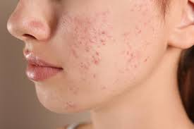 Acne scars Treatment in Surat